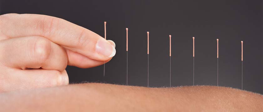 Acupuncture